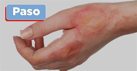 lapnos first aid|Paso: Sanhi, Sintomas, at Gamot .